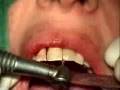 Immediate implantation and loading-Front tooth