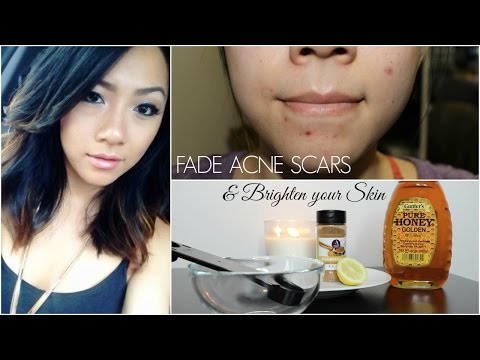 how to lighten acne scars naturally