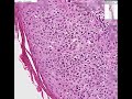 Histopathology Skin--Actinic keratosis