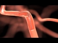 SolitaireTM FR Revascularization Device Product Animation