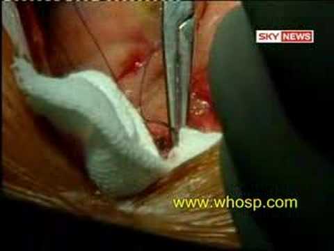 World's First Awake Cardiac Bypass & ...