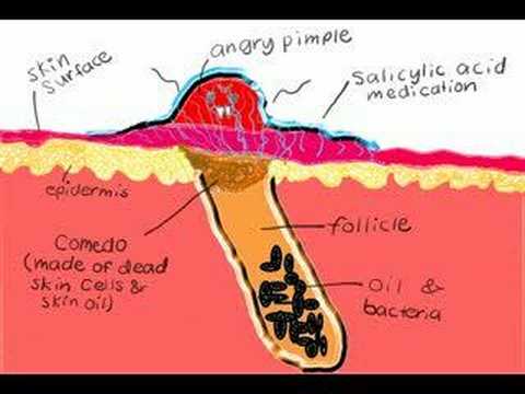 salicylic acid
