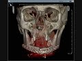 mouth cancer / oral carcinoma bone transplant