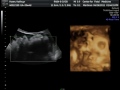 Sophia 39 week ultrasound dvd