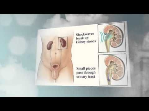 how to dissolve oxalate kidney stones