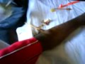 Dr Satish Rao - Ganglion excision surgery