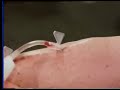 TECHNIQUE OF SELF HEMODIALYSIS TECHNIQUE OF SELF HEMODIALYSIS
