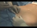 Smart Lipo Informational Video