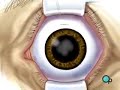 PreOp Patient Education: Cataract Small Incision Eye pt.1