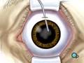PreOp® Patient Education: Cataract Small Incision Eye pt.1