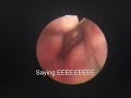 Viral Laryngitis in Patient w/History of LPR Viral Laryngitis in Patient w/History of LPR