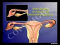 Ectopic Pregnancy Treatment