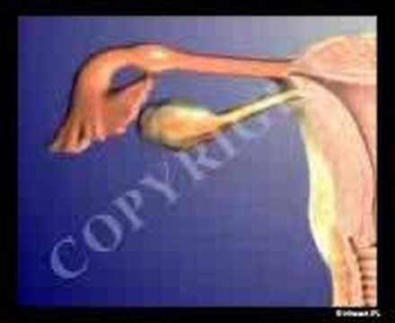 how to cure ectopic pregnancy