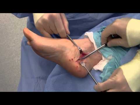 Dr. Sherman Nagler - Tarsal Tunnel Decompression