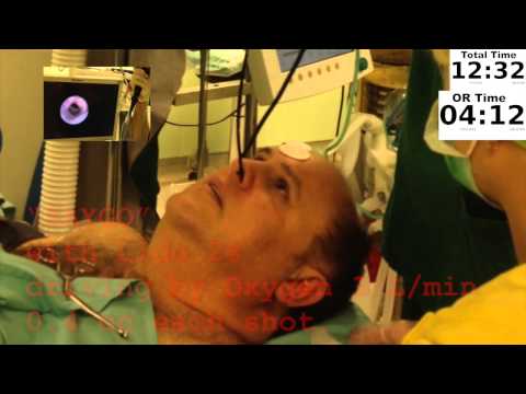 how to perform awake fiberoptic intubation