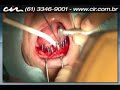 08 - Protocolo inferior com carga imediata Cl�nica Cir