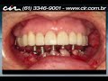 08   protocolo inferior com carga imediata clínica cir