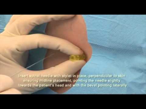 how to perform spinal anesthesia