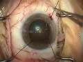 Cataract Surgery: IFIS using Iris Retractors, Pt. 1 of 2