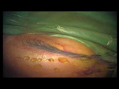 how to drain frontal sinuses