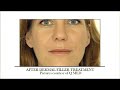 Anti aging injections informational video
