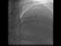 Exame de Cineangiocoronariografia - Paciente com Obstrução na Coronária
