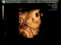 ECOGRAFIA DE ALBA RIZEK HERNANDEZ DE 29 SEMANAS ECOGRAFIA DE ALBA RIZEK HERNANDEZ DE 29 SEMANAS