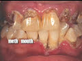 Decent Into Meth