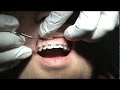 Supra-Crestal Fiberotomy