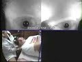 BPPV Rigiht Ear
