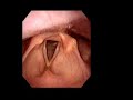 Brian Nelson Loses Voice Box June 2008 Video Stroboscopy Laryngoscopy August 21, 2008  Is this related to my cancer? Chemo?  Age? Larynx Taken at MD Anderson Cancer Center. Seeing a specialist 9-3. Camera through mouth nose. PLease comment. Mouth Disorders