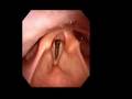 Brian Nelson Loses Voice Box June 2008 Video Stroboscopy Laryngoscopy August 21, 2008 Is this related to my cancer? Chemo? Age? Larynx Taken at MD Anderson Cancer Center. Seeing a specialist 9-3. Camera through mouth nose. PLease comment.