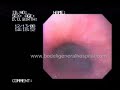 Normal Upper GI Endoscopy , Gujarat, India , Bodeli