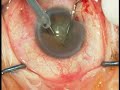 Phaco Vertical Chop, Dennis Lu, M.D. Phaco Vertical Chop, Dennis Lu, M.D.