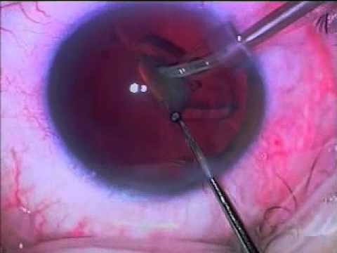 how to cure presbyopia
