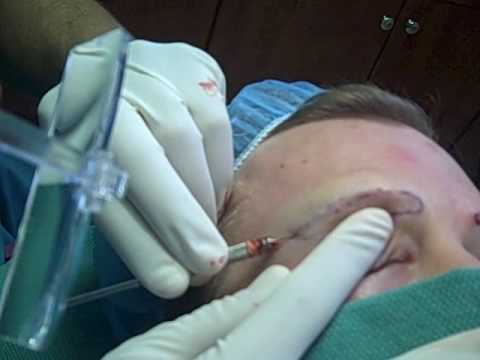 how to transplant eyebrows