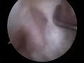 Operacion rodilla ligamentos Cruzados Operacion rodilla ligamentos Cruzados