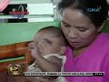Batang hindi maidilat ang isang mata, nangangailangan ng tulong medikal