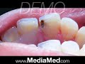 Tooth-Colored Fillings-Composite Fillings-Dental