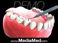 Tooth-Colored Fillings-Composite Fillings-Dental Tooth-Colored Fillings-Composite Fillings-Dental