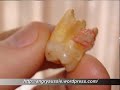 gross-the-wisdom-teeth-of-mr-angry.html