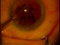 Cataract Surgery with ReStor Multifocal IOL by Dean Dornic, MD Cataract Surgery with ReStor Multifocal IOL by Dean Dornic, MD