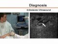 abscesso