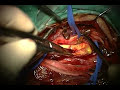 Carotid endarterectomy