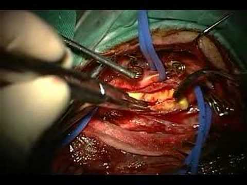 how to unclog arteries surgery