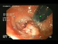Excision Of Polyp In Rectum Excision Of Polyp In Rectum