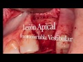 Tabla vestibular - Implante Frontier