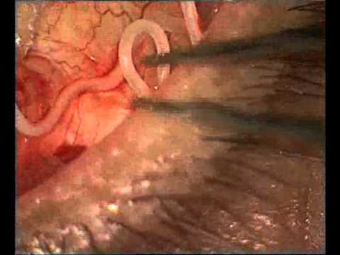 0 photo 0 Massive Worm Removed from Man’s Eye picture