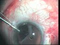 scleral fixation of dislocated iol.wmv