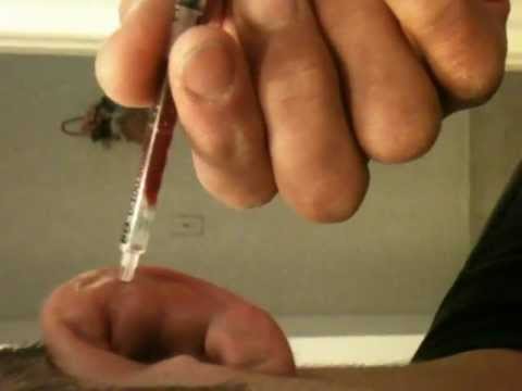 how to treat cauliflower ear